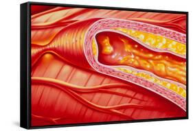 Illustration of Coronary Artery Atherosclerosis-John Bavosi-Framed Stretched Canvas