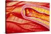 Illustration of Coronary Artery Atherosclerosis-John Bavosi-Stretched Canvas