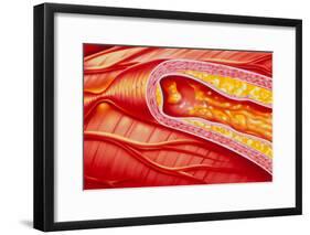 Illustration of Coronary Artery Atherosclerosis-John Bavosi-Framed Photographic Print