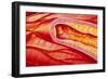 Illustration of Coronary Artery Atherosclerosis-John Bavosi-Framed Photographic Print