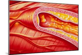 Illustration of Coronary Artery Atherosclerosis-John Bavosi-Mounted Photographic Print