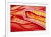 Illustration of Coronary Artery Atherosclerosis-John Bavosi-Framed Photographic Print