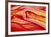 Illustration of Coronary Artery Atherosclerosis-John Bavosi-Framed Photographic Print