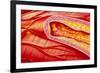 Illustration of Coronary Artery Atherosclerosis-John Bavosi-Framed Photographic Print