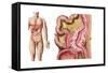 Illustration of Diverticulosis in the Colon-null-Framed Stretched Canvas