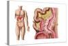 Illustration of Diverticulosis in the Colon-null-Stretched Canvas