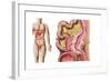 Illustration of Diverticulosis in the Colon-null-Framed Art Print