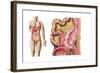 Illustration of Diverticulosis in the Colon-null-Framed Art Print
