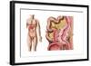 Illustration of Diverticulosis in the Colon-null-Framed Art Print