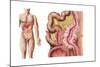 Illustration of Diverticulosis in the Colon-null-Mounted Art Print