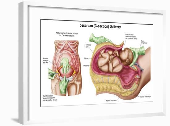 Illustration Showing Caesarean Delivery of Fetus-null-Framed Art Print