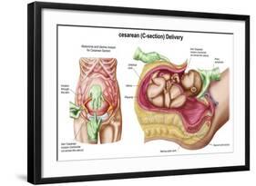 Illustration Showing Caesarean Delivery of Fetus-null-Framed Art Print