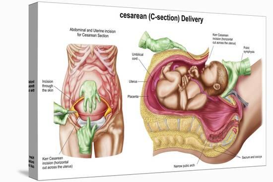 Illustration Showing Caesarean Delivery of Fetus-null-Stretched Canvas