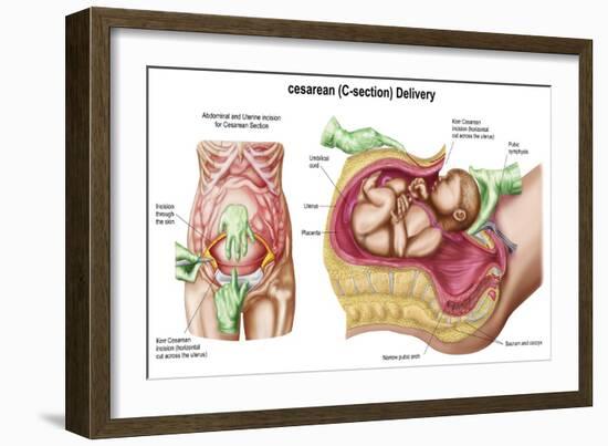 Illustration Showing Caesarean Delivery of Fetus-null-Framed Art Print