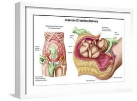 Illustration Showing Caesarean Delivery of Fetus-null-Framed Art Print