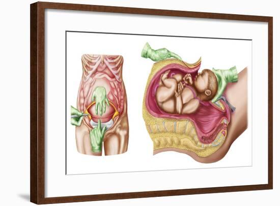 Illustration Showing Caesarean Delivery of Fetus-null-Framed Art Print