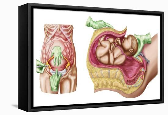 Illustration Showing Caesarean Delivery of Fetus-null-Framed Stretched Canvas