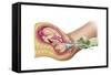 Illustration Showing Delivery of Fetus Using Vacuum Extraction-null-Framed Stretched Canvas