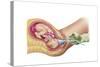 Illustration Showing Delivery of Fetus Using Vacuum Extraction-null-Stretched Canvas