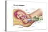 Illustration Showing Delivery of Fetus Using Vacuum Extraction-null-Stretched Canvas
