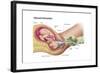 Illustration Showing Delivery of Fetus Using Vacuum Extraction-null-Framed Art Print