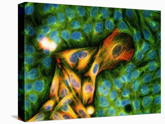 Immunofluorescent LM of Melanoma Cancer Cells-Nancy Kedersha-Stretched Canvas