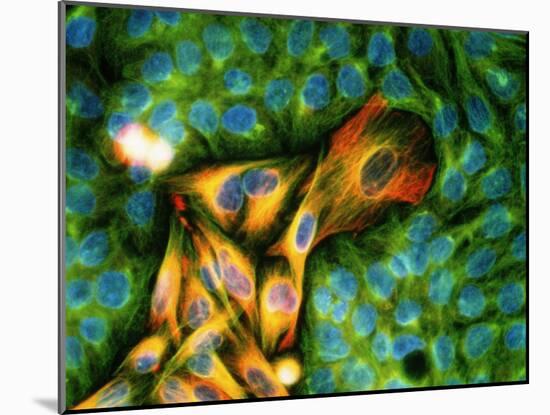 Immunofluorescent LM of Melanoma Cancer Cells-Nancy Kedersha-Mounted Photographic Print