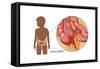 Inflamed Appendix-Monica Schroeder-Framed Stretched Canvas