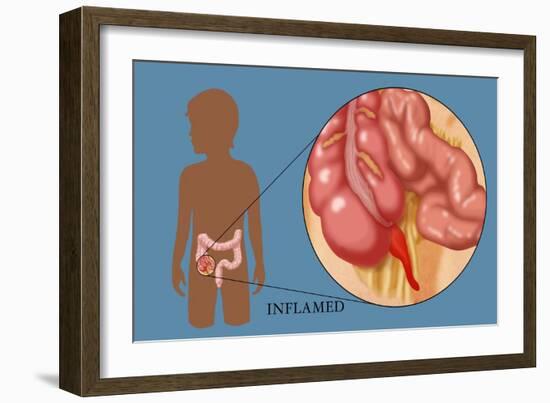 Inflamed Appendix-Monica Schroeder-Framed Giclee Print