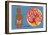Inflamed Appendix-Monica Schroeder-Framed Giclee Print