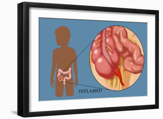 Inflamed Appendix-Monica Schroeder-Framed Giclee Print