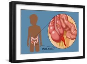 Inflamed Appendix-Monica Schroeder-Framed Giclee Print