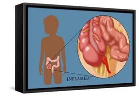 Inflamed Appendix-Monica Schroeder-Framed Stretched Canvas