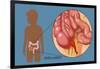 Inflamed Appendix-Monica Schroeder-Framed Giclee Print