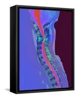 Inflamed Spinal Discs, MRI Scan-Du Cane Medical-Framed Stretched Canvas