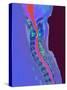 Inflamed Spinal Discs, MRI Scan-Du Cane Medical-Stretched Canvas