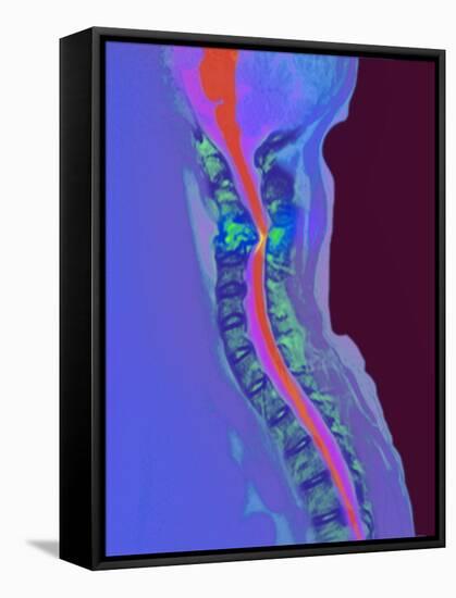 Inflamed Spinal Discs, MRI Scan-Du Cane Medical-Framed Stretched Canvas