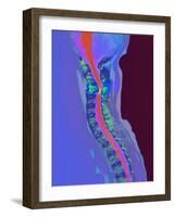 Inflamed Spinal Discs, MRI Scan-Du Cane Medical-Framed Photographic Print