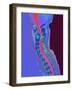 Inflamed Spinal Discs, MRI Scan-Du Cane Medical-Framed Photographic Print