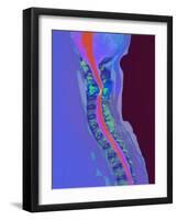 Inflamed Spinal Discs, MRI Scan-Du Cane Medical-Framed Photographic Print