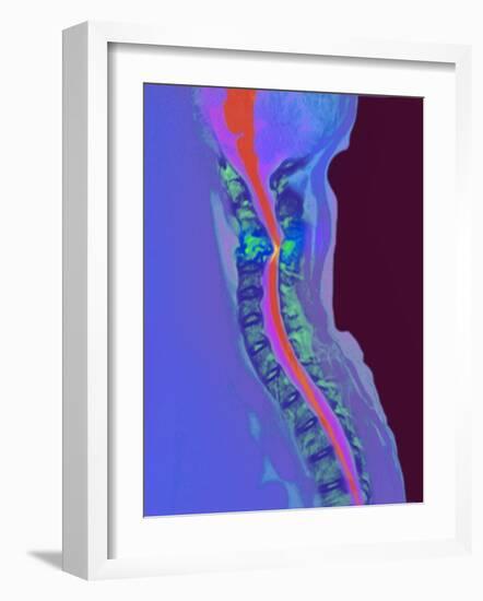 Inflamed Spinal Discs, MRI Scan-Du Cane Medical-Framed Photographic Print