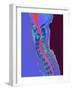 Inflamed Spinal Discs, MRI Scan-Du Cane Medical-Framed Photographic Print