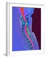 Inflamed Spinal Discs, MRI Scan-Du Cane Medical-Framed Photographic Print