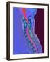 Inflamed Spinal Discs, MRI Scan-Du Cane Medical-Framed Photographic Print