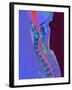 Inflamed Spinal Discs, MRI Scan-Du Cane Medical-Framed Photographic Print