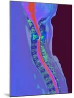 Inflamed Spinal Discs, MRI Scan-Du Cane Medical-Mounted Photographic Print