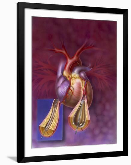 Insertion of Balloon into Atherosclerotic Artery-null-Framed Art Print