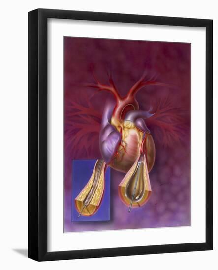 Insertion of Balloon into Atherosclerotic Artery-null-Framed Art Print