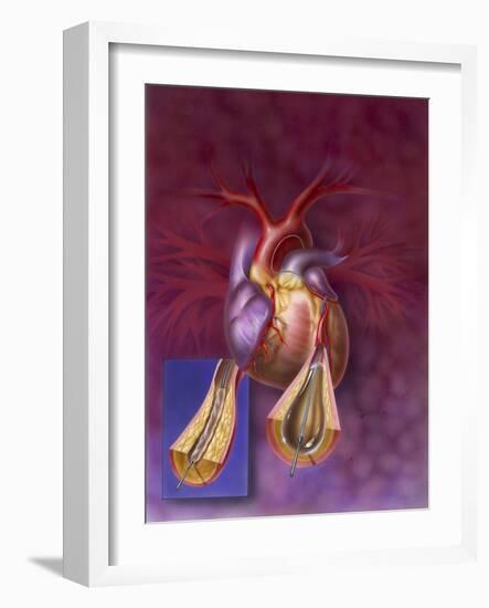 Insertion of Balloon into Atherosclerotic Artery-null-Framed Art Print