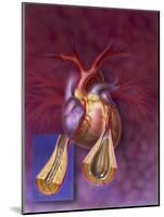 Insertion of Balloon into Atherosclerotic Artery-null-Mounted Art Print